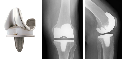 Oberflächenprothese Knie