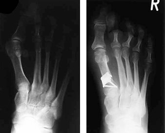 Röntgen-Aufnahmen vor- und nach Basisosteotomieg