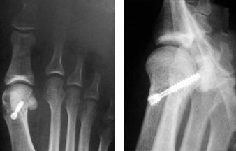 Gelenknahe Korrektur des Mittelfußknochens mit Ausschnittsvergrößerung
