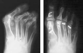 Hochgradige Vorfußdeformität vor und nach operativer Versorgung